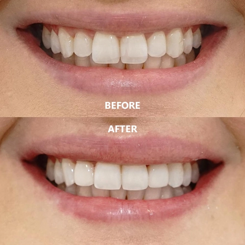 beforeafter composite.fw ezgif.com optiwebp