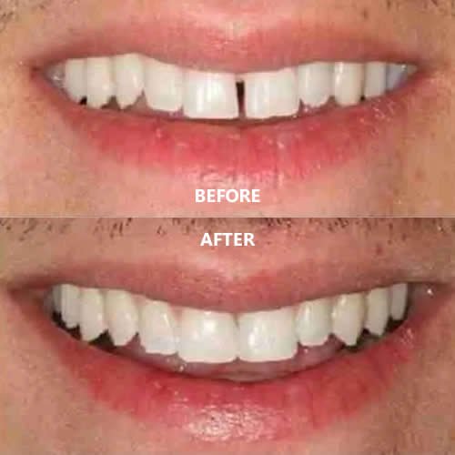 composite bonding leeds3
