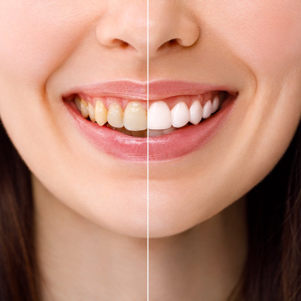 smiling woman before after teeth whitening procedure closeup image ezgif.com optiwebp